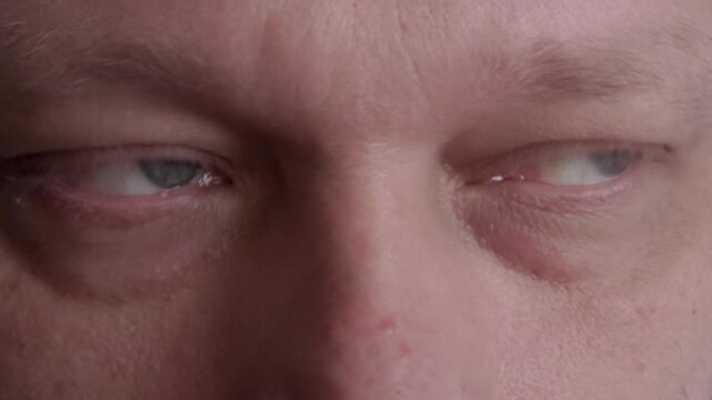 Close-up of human eyes with redness and swelling of the lower eyelid. Tired look