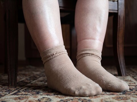 A detail shot of the feet and ankles of an elderly person suffering from chronic heart failure sitting on a chair, the skin taut and ankles visibly swollen with the mark left by the sock's elastic ban