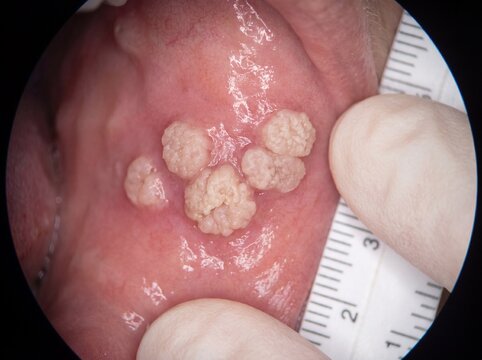 A detailed clinical shot of an HPV infection showing fleshy skin growths shaped like a cockscomb or small cauliflower on the surface of the mucosa, professional photography.