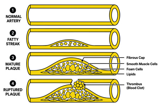 Stages of atherosclerosis and plaque formation in artery Vector