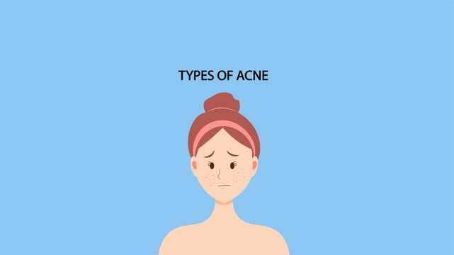 Medical vector animation showing common acne lesion categories on facial skin. Educational dermatology concept for skincare awareness, diagnosis, treatment guidance, and healthcare content.