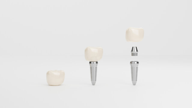 Clean 3D illustration showing dental implant assembly stages with ceramic crowns, metal abutments, and titanium screws on white background