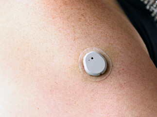Fototapeta premium Smart Wireless Continuous Glucose Monitor Sensor Patch Close Up on Woman's Upper Arm