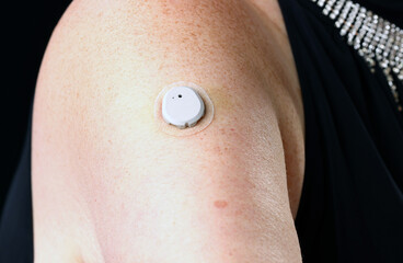 Fototapeta premium Innovative Subcutaneous Glucose Tracking Sensor for Advanced Diabetes Care and Wellness