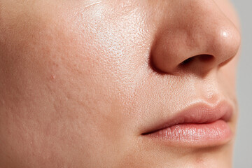 Obraz premium Oily skin shine clogged pore cheek nose close up Close up shinny cheek and nose with visible oily skin, shine, enlarged pores and mild acne scarring creating realistic skin texture and natural