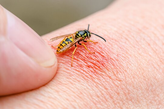 Yellow jacket wasp stinging human skin with red irritation, ideal for first aid, allergy, and insect bite safety content.