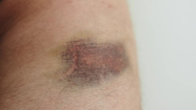 Large hematoma on upper part of male hairy thigh, close up. Consequences of injury after bruise. Subcutaneous blood leakage at spot of leg impact.