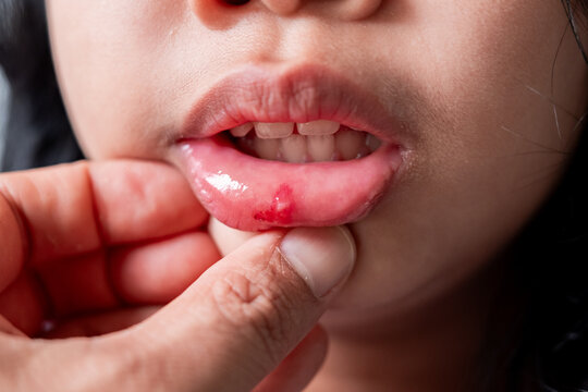 Close-up of a parent's hand gently checking a painful mouth ulcer or canker sore on a child's lower lip. Ideal for medical, pediatric healthcare, oral hygiene, and dental care concepts.