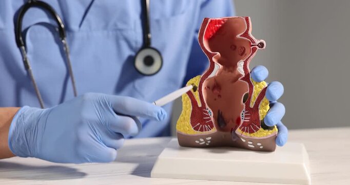 Doctor showing model of unhealthy lower rectum with inflamed vascular structures at light wooden table in clinic, closeup