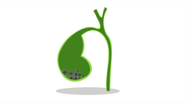 Medical vector animation showing inflamed gallbladder with stone blockage and enlargement. Educational healthcare concept illustrating digestive system disorder, abdominal pain, and diagnosis.