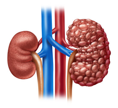 Chronic Kidney Disease concept or CKD as Human kidneys concept as one healthy and polycystic disease with cysts as anatomy of the urinary system as a medical illustration anatomy diagram.
