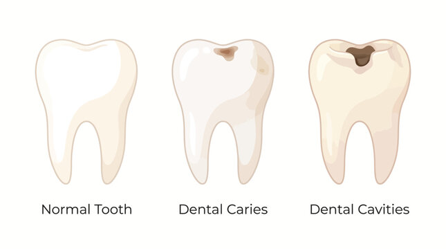 Educational illustration comparing a healthy tooth, dental caries, and dental cavities in three stages