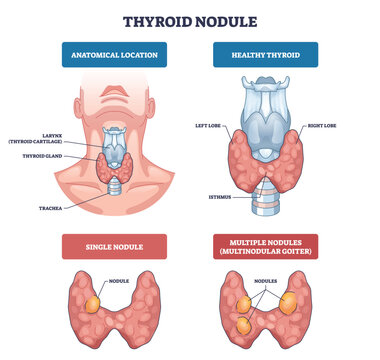 Thyroid nodules diagram compares healthy gland and nodule types, showing thyroid gland, larynx, and nodules for quick anatomy insight. Outline diagram