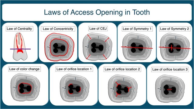 Laws of Endodontic Access Opening in Tooth Chart