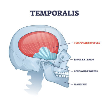Temporalis muscle in skull with anatomical head skeleton outline diagram, transparent background. Labeled education scheme with skull exterior, coronoid process and mandible illustration.