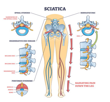 Sciatica pain or nerve weakness as leg lumbar radiculopathy outline diagram, transparent background. Labeled educational back inflammation.