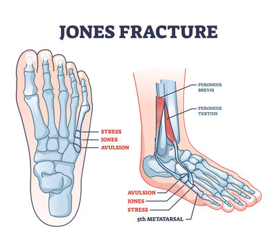 Jones fracture and foot pinky finger bone broken damage outline diagram, transparent background. Labeled educational scheme with bone stress or avulsion sections vetor illustration.