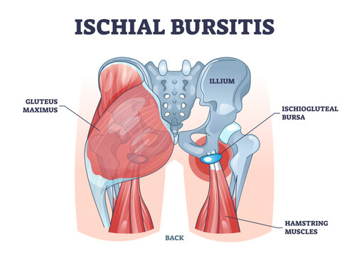 Ischial bursitis or ischiogluteal weaver's bottom condition outline diagram, transparent background. Labeled educational scheme with muscle inflammation and liquid filled bursa illustration.