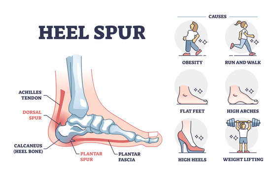 Heel spur problem or calcaneal bone condition causing pain in feet outline diagram, transparent background. Labeled educational medical scheme.