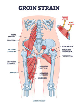 Groin strain trauma and pulled or torn muscle injury anatomy outline diagram, transparent background. Labeled educational medical sport problem explanation.