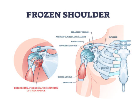 Frozen shoulder condition or adhesive capsulitis syndrome outline diagram, transparent background. Labeled educational medical diagnosis with pain and stiffness around body upper part.