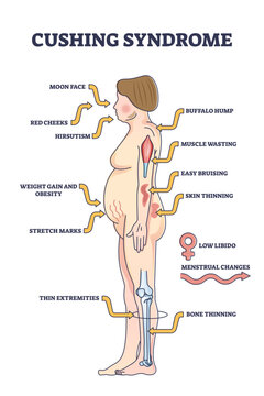 Cushing syndrome symptoms list from high cortisol level outline diagram, transparent background. Labeled educational medical scheme.