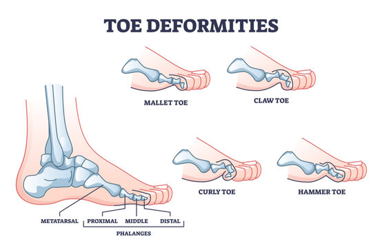 Toe deformities and foot phalanges bone defects outline diagram, transparent background. Labeled educational scheme with proximal, middle and distal skeleton and mallet, claw, curly.