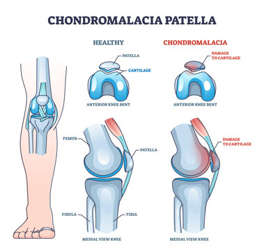 Chondromalacia patella knee breakdown compared with healthy outline diagram, transparent background. Labeled educational kneecap tissue damage.