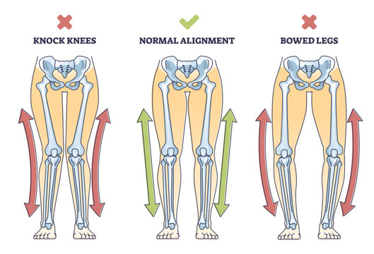 Bowed legs syndrome with normal and knock legs comparison outline diagram, transparent background. Labeled educational physical defect with outward bending and knees does not touch illustration.