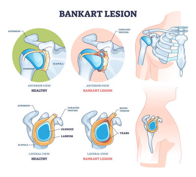 Bankart lesion as anterior part of the glenoid labrum trauma outline diagram, transparent background. Labeled educational medical injury type with anterior and lateral view of xray.