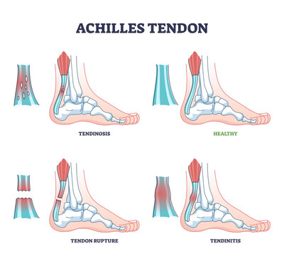 Achilles tendon injury as leg or ankle trauma outline diagram, transparent background.Labeled educational inflammation and orthopedic ligament conditions illustration.