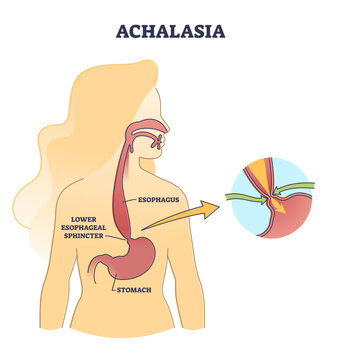 Esophageal achalasia disease with lower sphincter opening failure outline diagram, transparent background. Labeled educational smooth muscle fibers condition explanation.