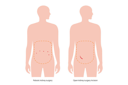 Kidney transplant surgery