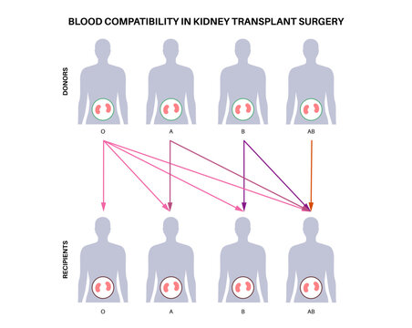 Kidney transplant surgery