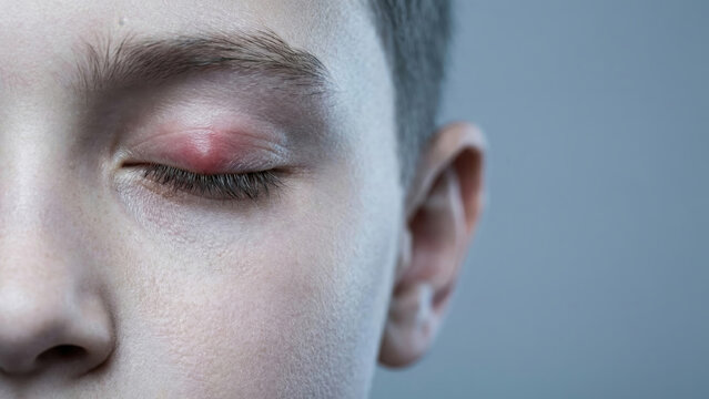 Young person's closed eye affected by a red, swollen, and painful sty on the upper eyelid.