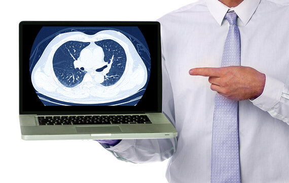 Doctor in white shirt and tie pointing at CT scan of chest on laptop screen, showing lung and heart cross-section, isolated on white background. Radiology medical concept.