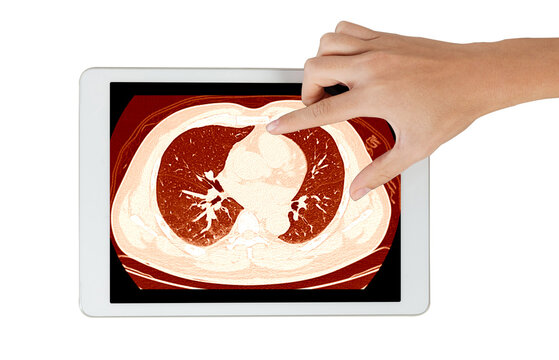 Hand touching CT scan of chest displayed on tablet screen with warm orange tone, showing lung and mediastinum cross-section, isolated on white background. Digital radiology and telemedicine concept.