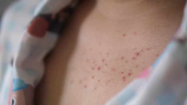 Cinematic close-up of inflammatory acne, papules, and pustules on a young woman's chest, dermatology concept
