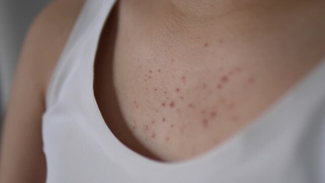 Cinematic close-up of inflammatory acne, papules, and pustules on a young woman's chest, dermatology concept