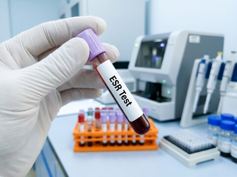 Erythrocyte Sedimentation Rate ESR blood test sample in pathology laboratory for inflammation screening and diagnostic healthcare concept