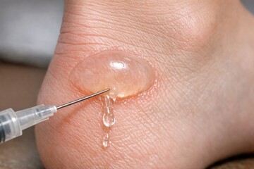 Fototapeta premium A person injured with a needle stuck in their foot, suitable for medical or first aid themed images