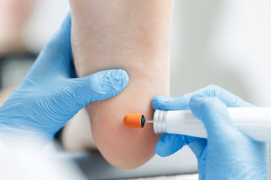 Podiatrist treating foot callus with tool, closeup care for healthier feet