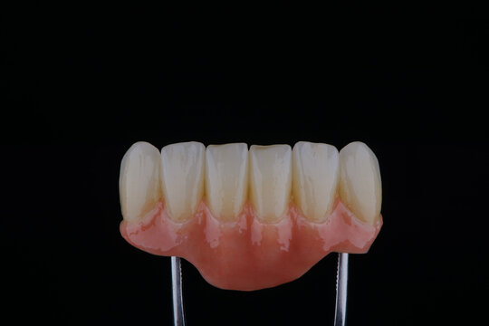 Dental bridge with artificial gum made of zirconium on two titanium abutments to fixation on implant