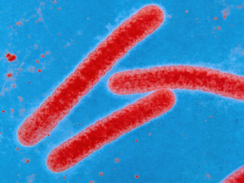 Original image of Mycobacterium tuberculosis stained with Zir-Nielsen acid-fast stain, showing characteristic red acid-fast bacilli against a blue background, from a clinical sputum sample.