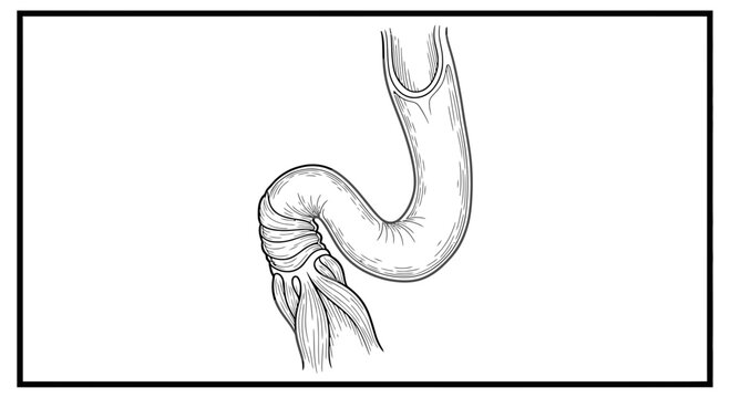 Medical illustration of intestinal obstruction, twisted bowel loop, surgical view