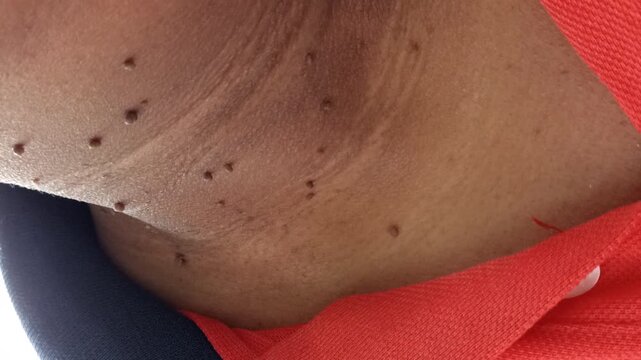 Macro Shot Focused on Dermatological Skin Tags on Male Upper Torso Body
