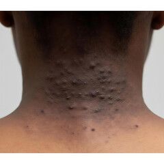 Fototapeta premium Neck skin of a person shows dark hyperpigmentation and multiple small bumps that require a professional medical evaluation by a licensed dermatologist for an accurate diagnosis and treatment plan.