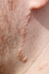 Fototapeta premium Close-up of human skin scar near ear