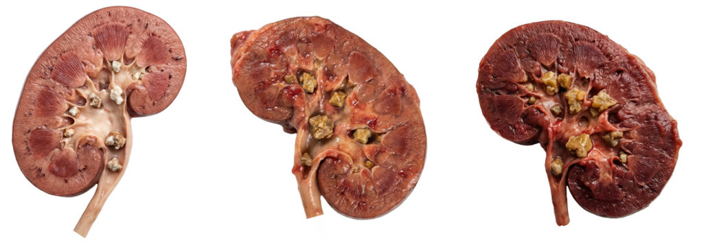 Gross pathology of a human kidney cross section showing multiple large calculus stones lodged within the renal pelvis and calyces, isolated on a transparent background.