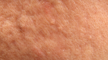 Naklejka premium Macro closeup of human skin showing a raised mole or skin with visible pores uneven texture